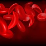 illustration of sickle cell anemia blood cells for a look into sickle cell anemia treatments