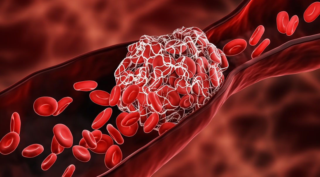 Bladder Cancer and Blood Clots (Thromboembolism)